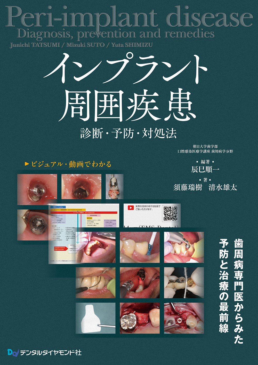 刊行にあたって：インプラント周囲疾患 診断・予防・対処法｜本の