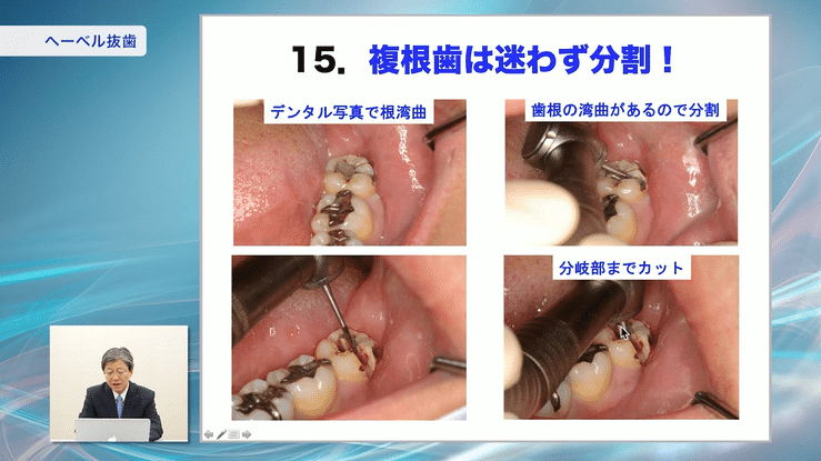 株式会社 医療情報研究所 | 難症例も単純化！学校では教えてくれない抜歯術
