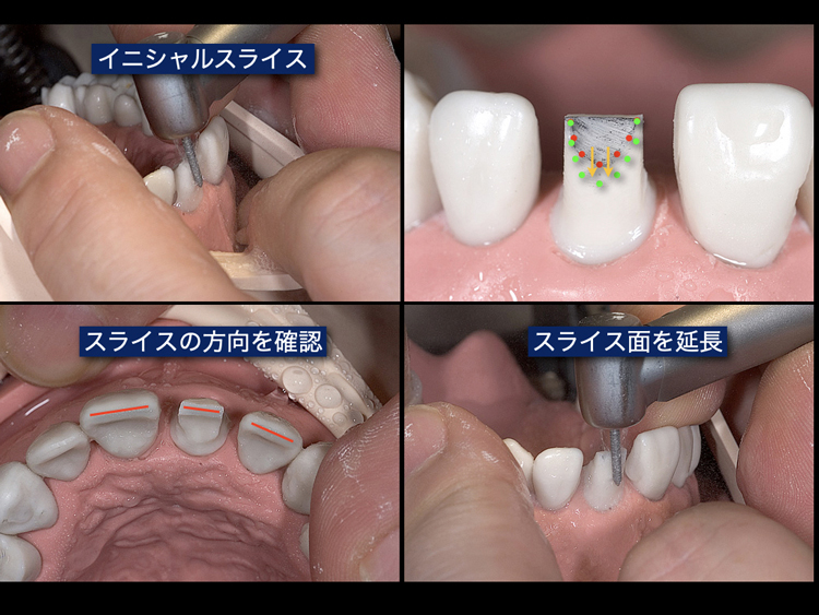 速く・上手に！誰でもできる支台歯形成テクニック | 株式会社 医療情報