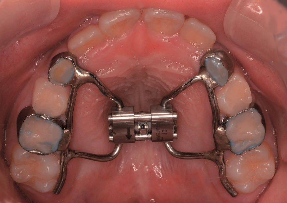 顎整形力を発揮する矯正装置 - Dental Note