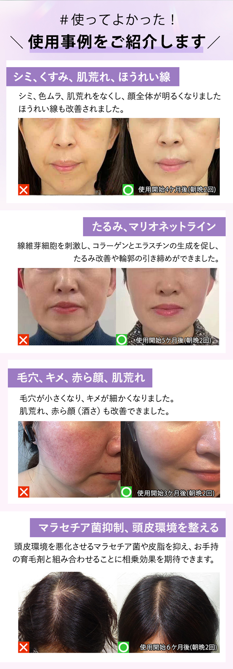 瞬間美肌のプラズマ美顔器 Un（アン) | エイジングケア・ニキビ予防