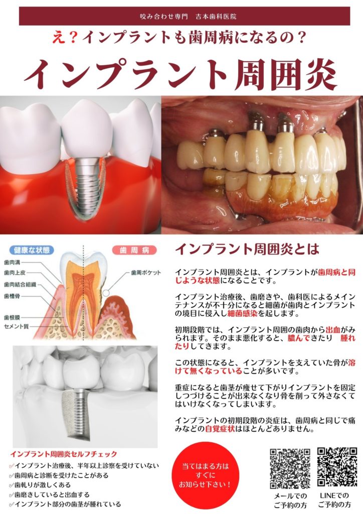 え？インプラントも歯周病になる？ | お知らせ | 吉本歯科医院 | 病院