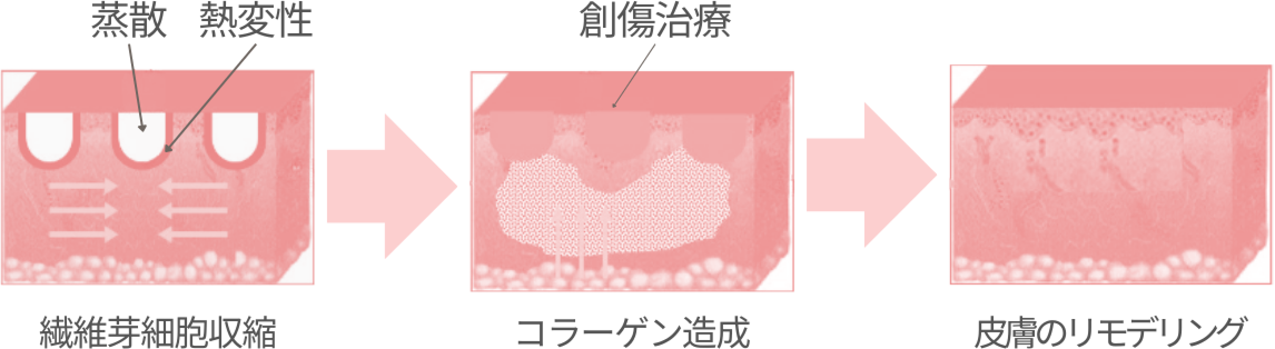 モナリザタッチ（腟レーザー治療） – 港区、品川区の産婦人科で妊婦健