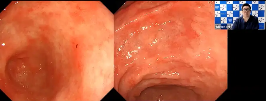 萎縮性胃炎とピロリ菌感染の診断、内視鏡所見も踏まえて解説