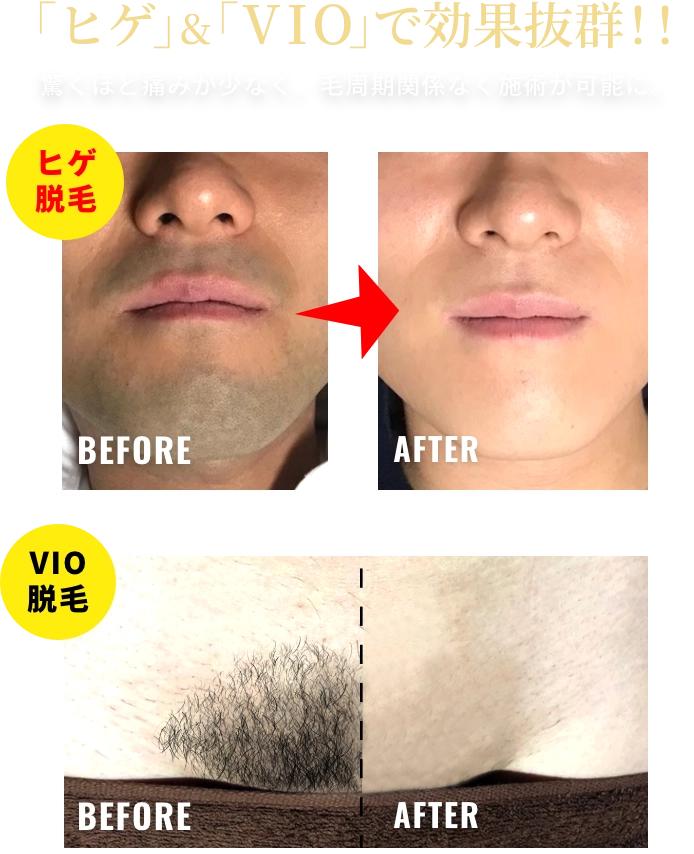 👑脱毛ビジネスのご案内👑 業務用脱毛機 LUMIX-A9X ルミクスエーナイン