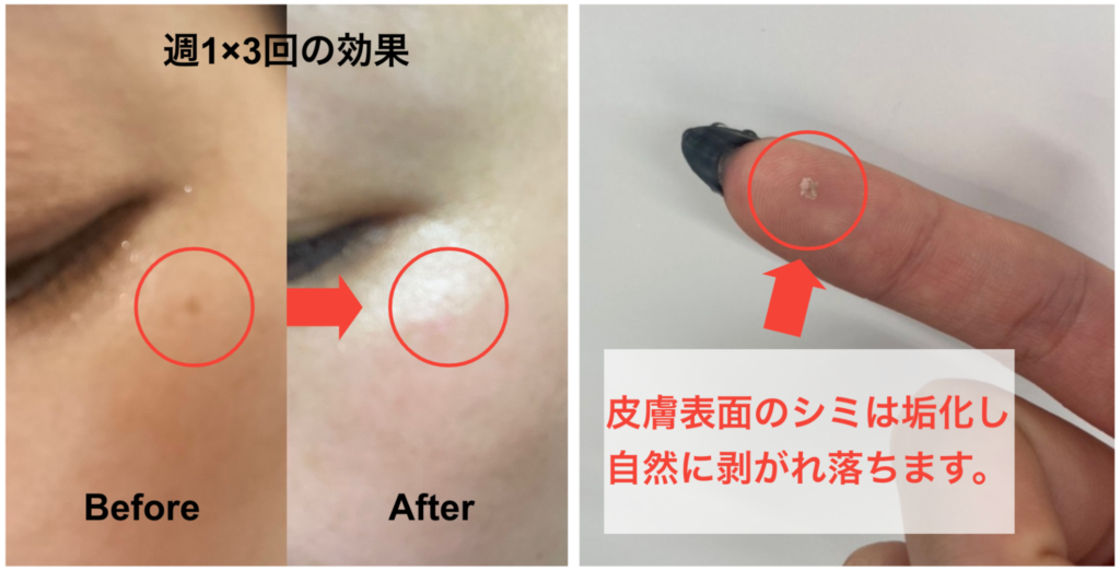 廃盤】業務用シミ取り｜シミポレーションとは？特徴や効果、マシン価格