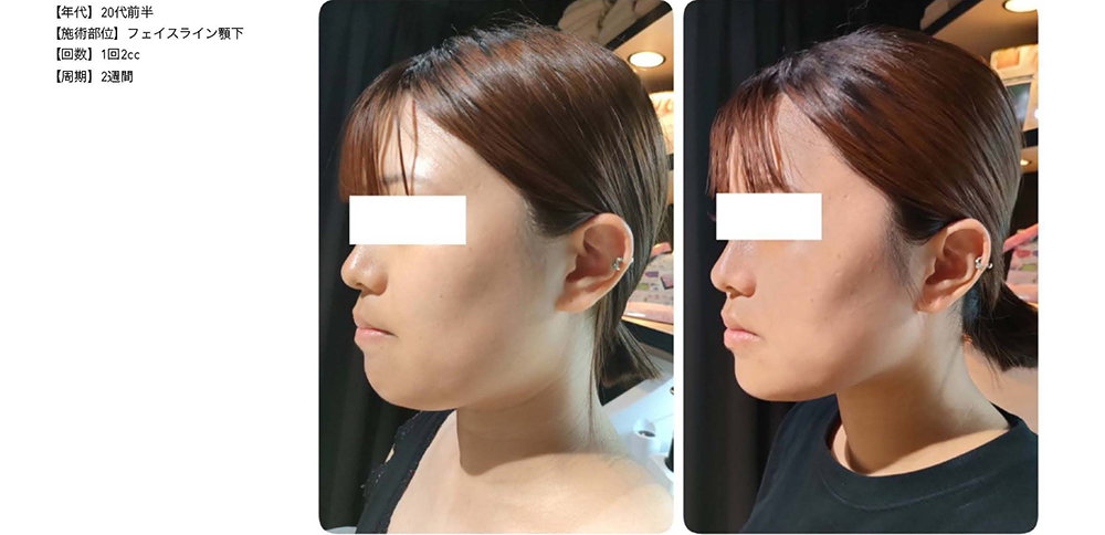 リピーター限定＞レモンボトル（10ml×5） 脂肪分解／脂肪溶解剤 特典付