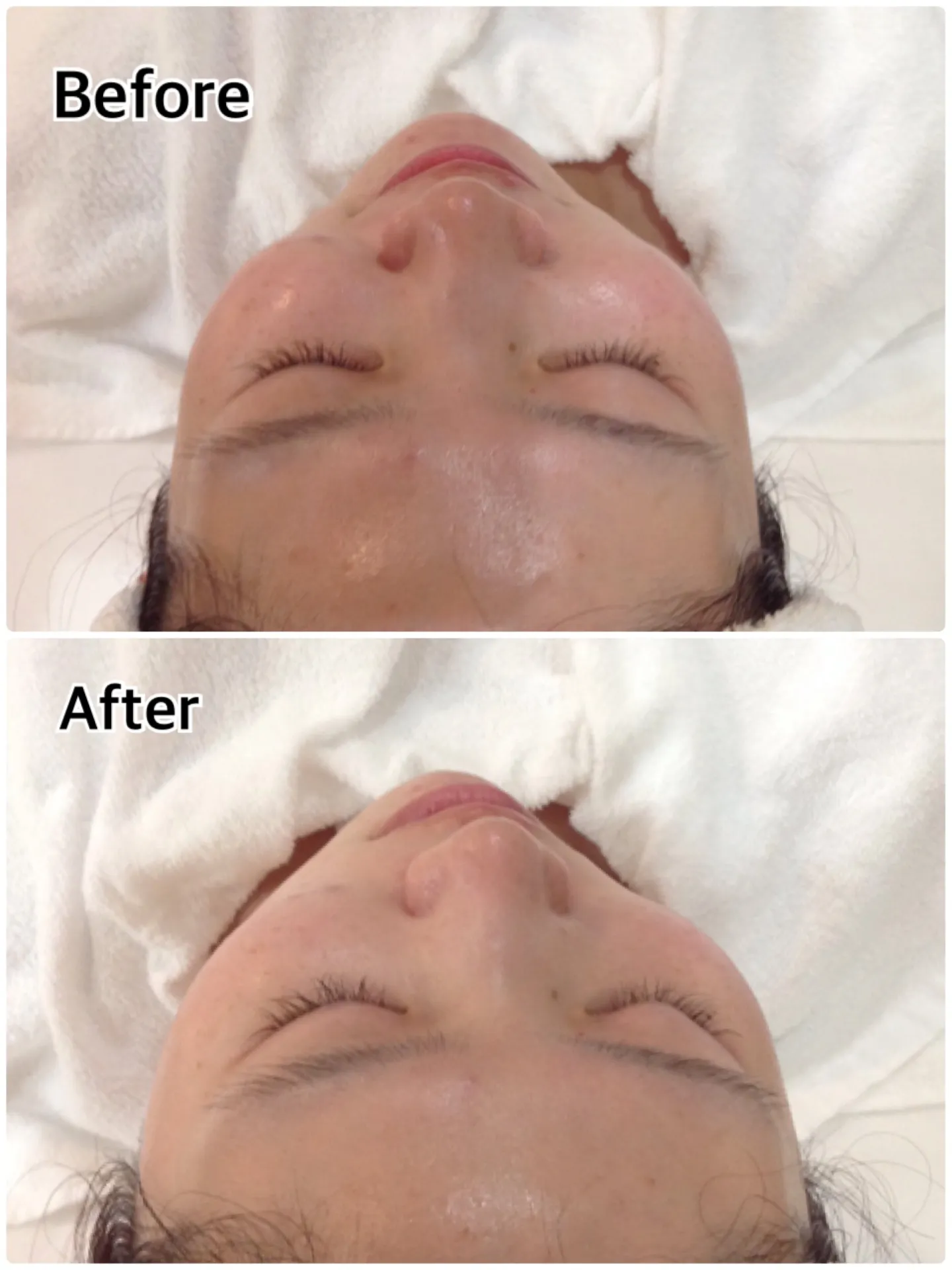 スクライバー洗浄（美顔） 高木 | スタッフブログ | 熊本・鹿児島