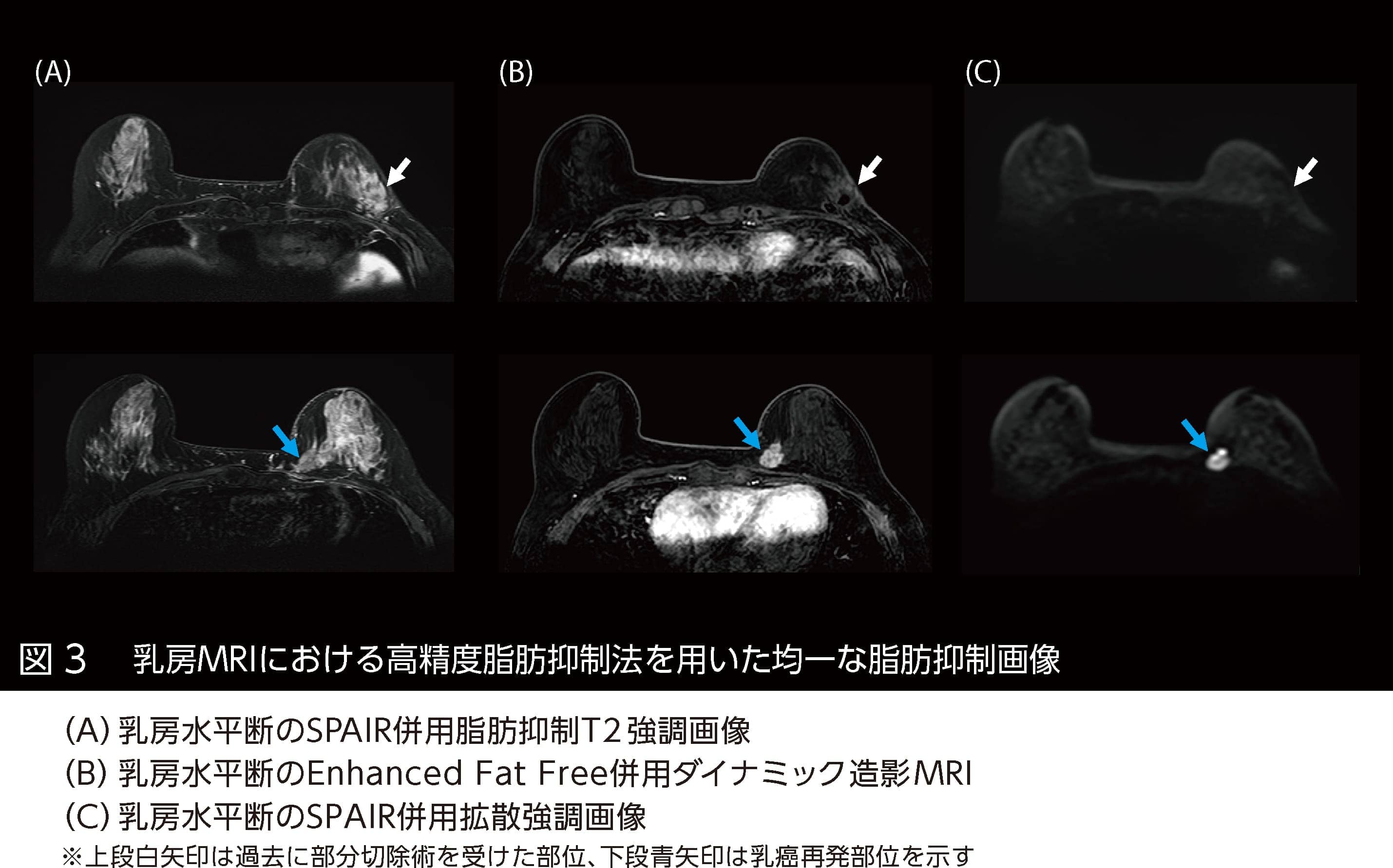 Vantage Galan 3T / Supreme Editionは3T MRIの新境地を切り拓くのか