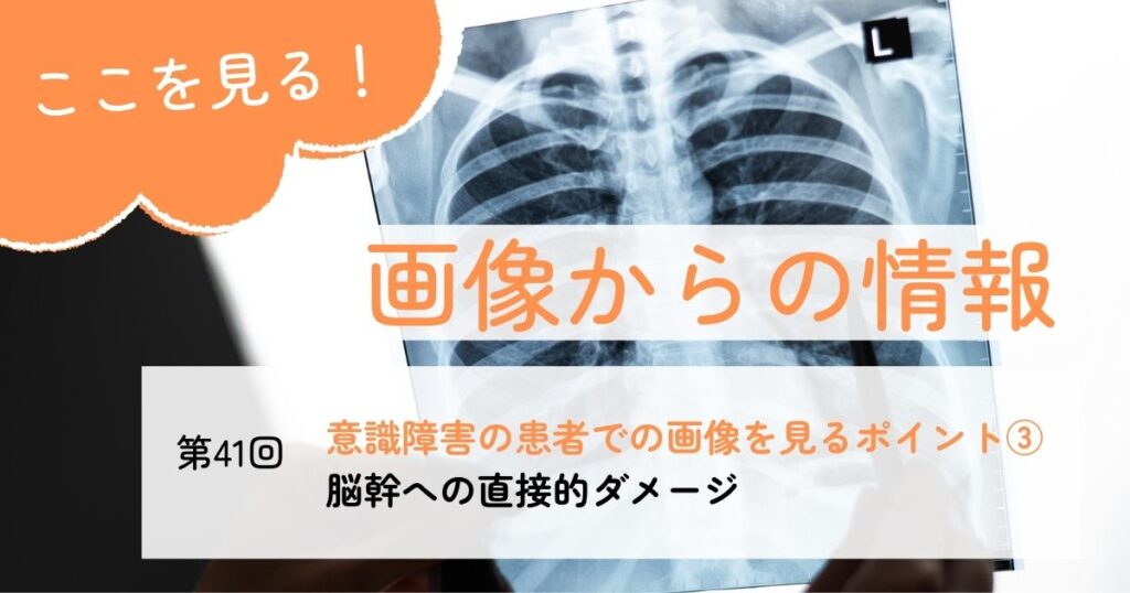 覚醒の障害がある患者で脳幹出血を画像で見るポイント#41