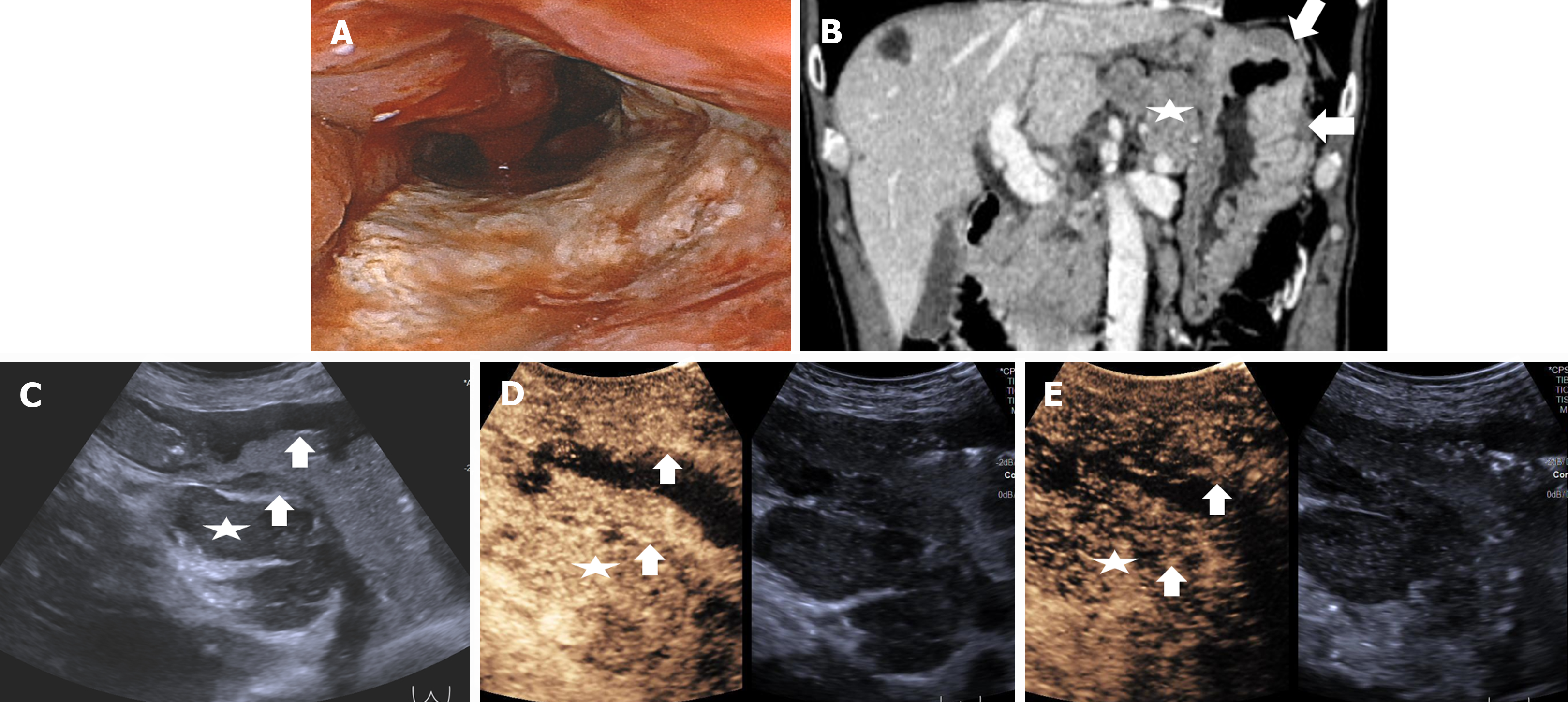 Double contrast-enhanced ultrasonography improves diagnostic