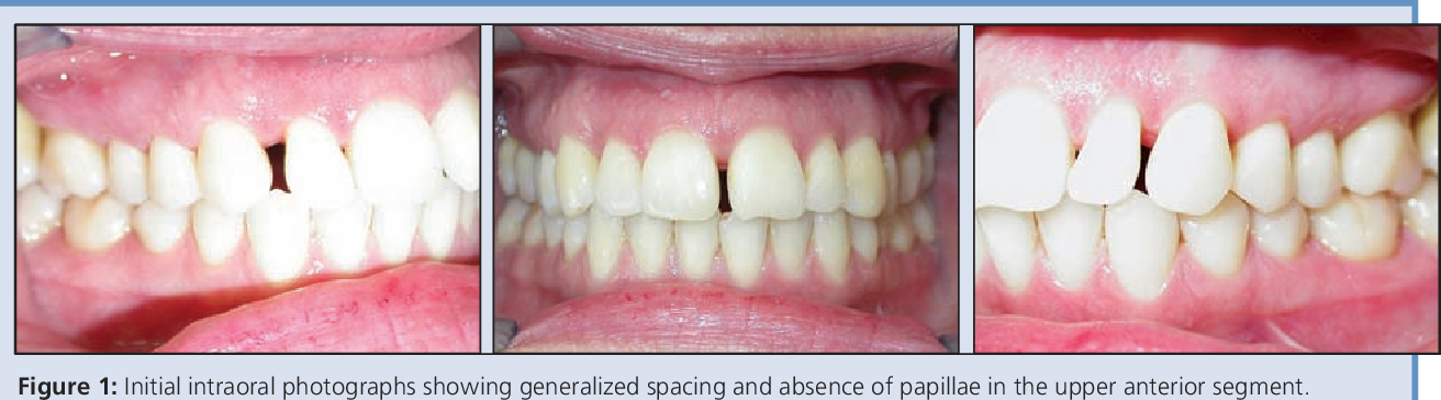 Figure 1 from Interdental papilla reconstruction combining
