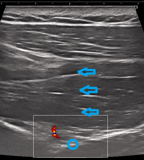 超音波ガイド下肩甲上神経ブロック: ☆藤井脳神経外科・整形外科
