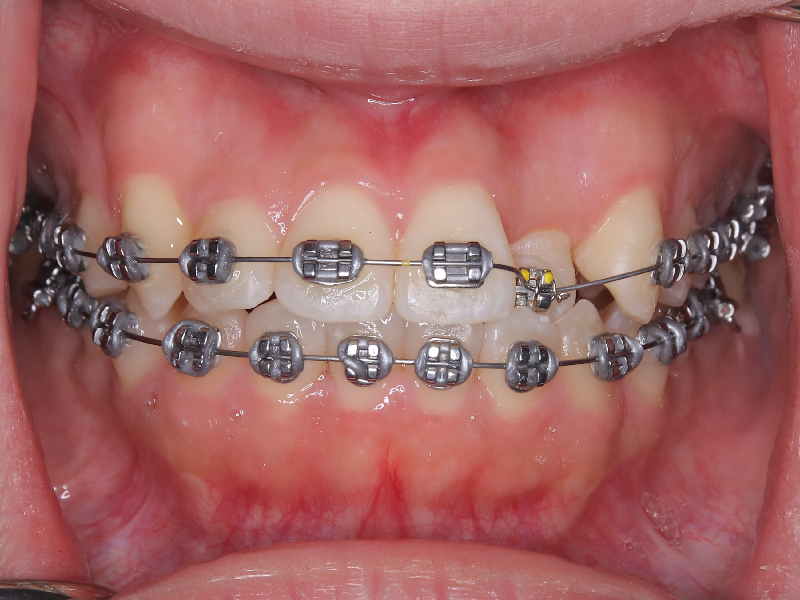 矯正治療で失敗や後悔? | 諫早市の歯医者諫早ふじた歯科・矯正歯科