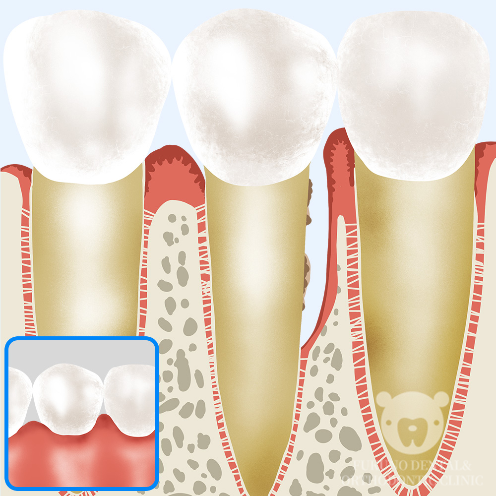 歯周組織再生療法 | 小田急相模原の歯科医院（歯医者）｜ふくの歯科