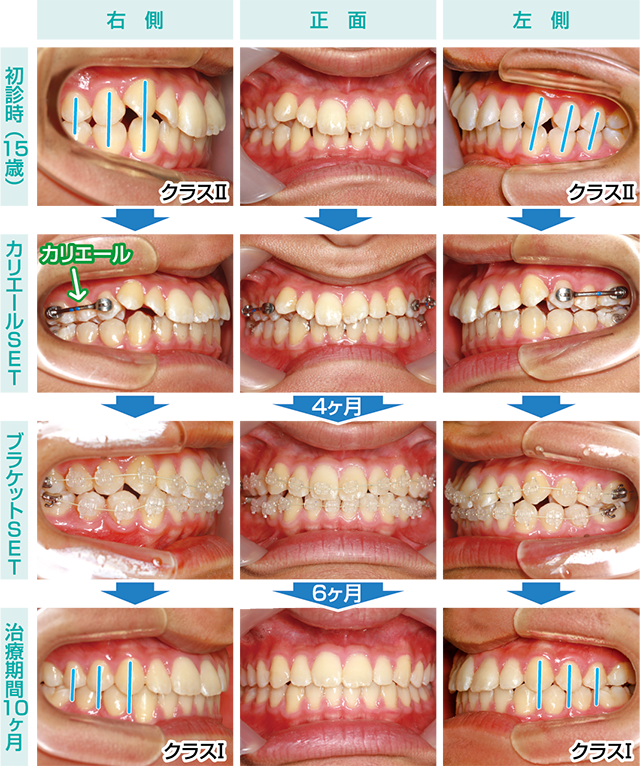 No.139 カリエールを用いた非抜歯矯正治療 | ふかつ歯科・矯正歯科