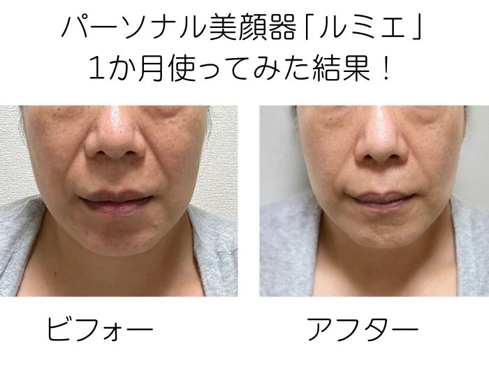 最新美顔器「ルミエ」を忖度なしに1か月使ってみた！ 素肌に自信の