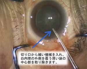 小切開白内障手術 | 京都府立医大病院眼科