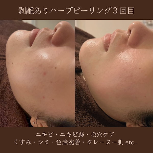 Qoo10] DAPPY（剥離ありハーブピーリング2回