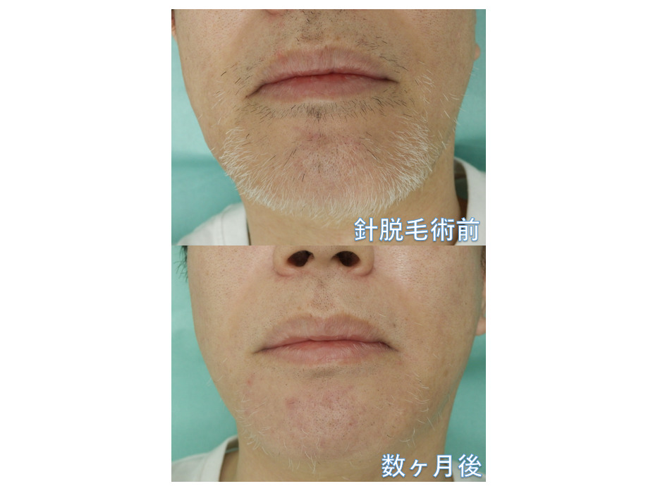 針脱毛 白髪に対して唯一効果のある脱毛方法 | 東京・銀座でメンズ