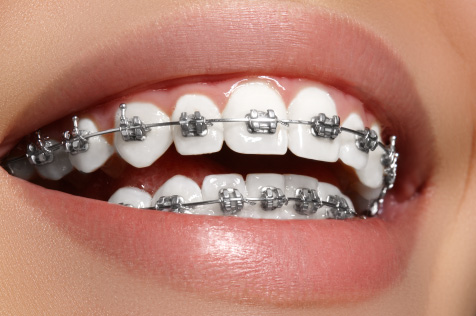 矯正治療について | 子供から大人向けの矯正歯科 愛知県一宮市 駅前の