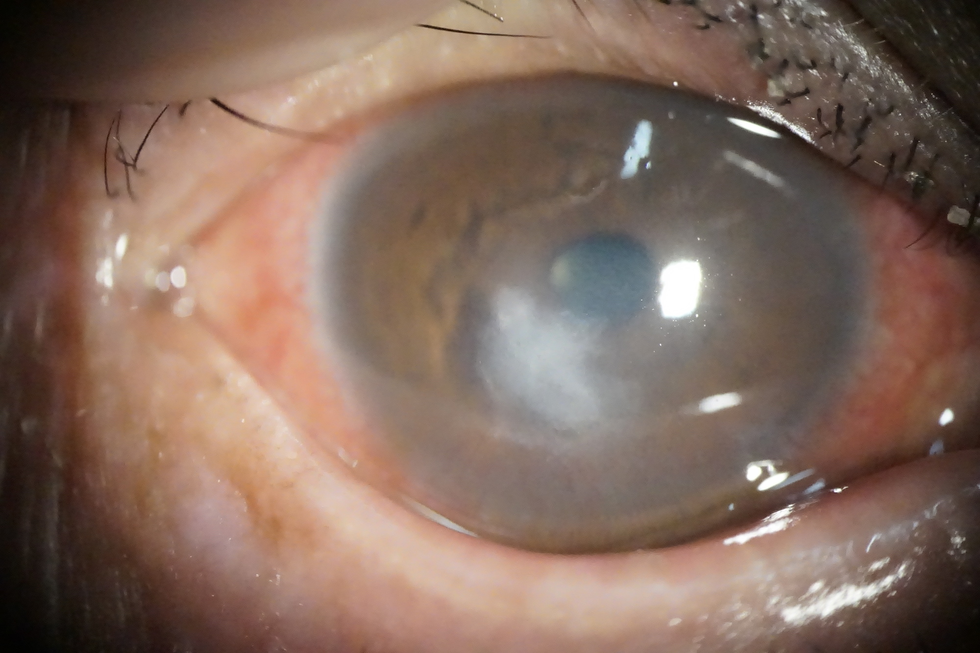 角膜感染症｜尼崎市宮内町にある萩原眼科クリニック