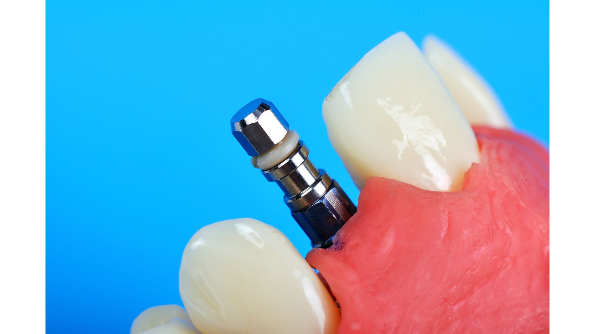 矯正とインプラント、どっちが先？順番を間違えると後悔します！｜博多