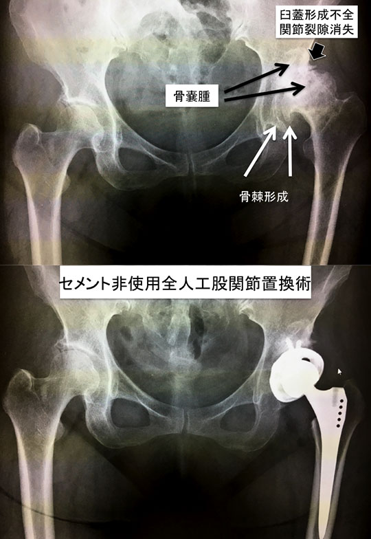壮年期、老年期の骨 関節疾患｜はっとり整形外科・リウマチ科