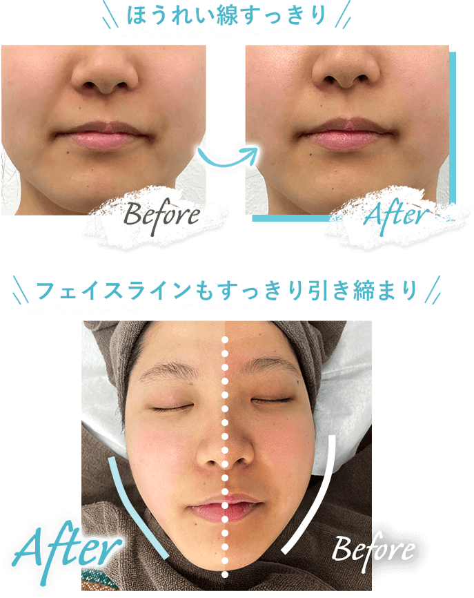 都度払い医療ハイフ（HIFU）HINATA CLINIC 新宿 全顔32,000円