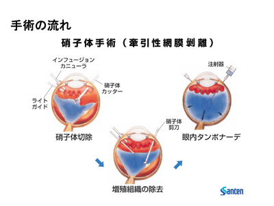 硝子体手術 - 目の病気と治療 - ひかる眼科（川口市蕨市） - ひかる眼科