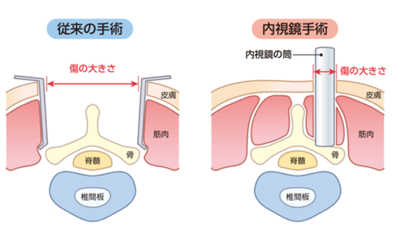 脊椎内視鏡手術｜平井整形外科クリニック｜横浜市港北区綱島の整形外科