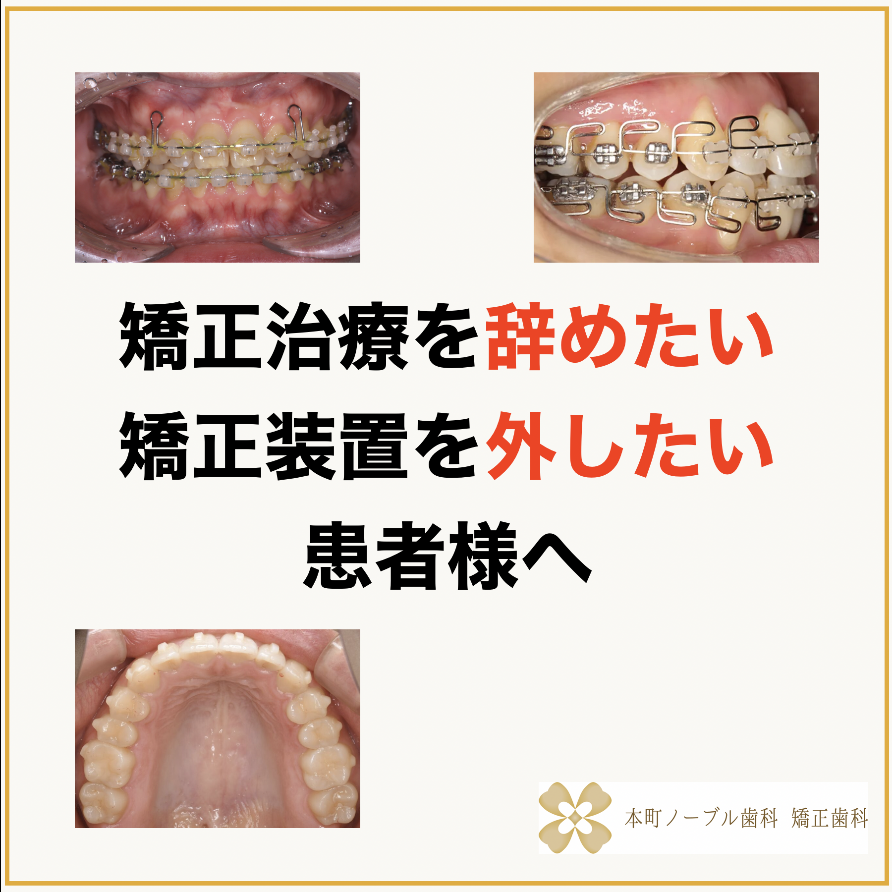 矯正治療を辞めたい矯正装置を外したい患者様へ - 本町の矯正・歯科