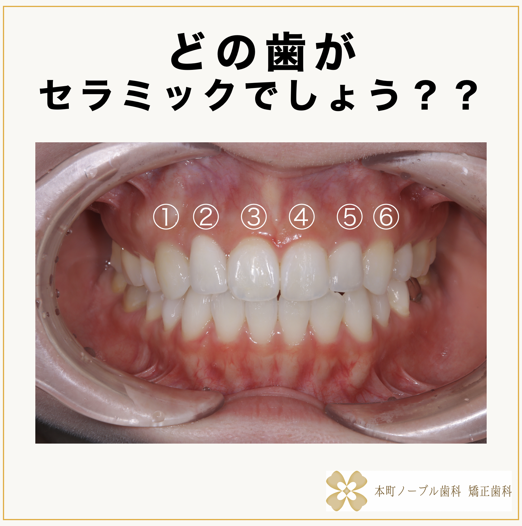 どの歯がセラミックでしょう？ - 本町の矯正・歯科 本町ノーブル歯科