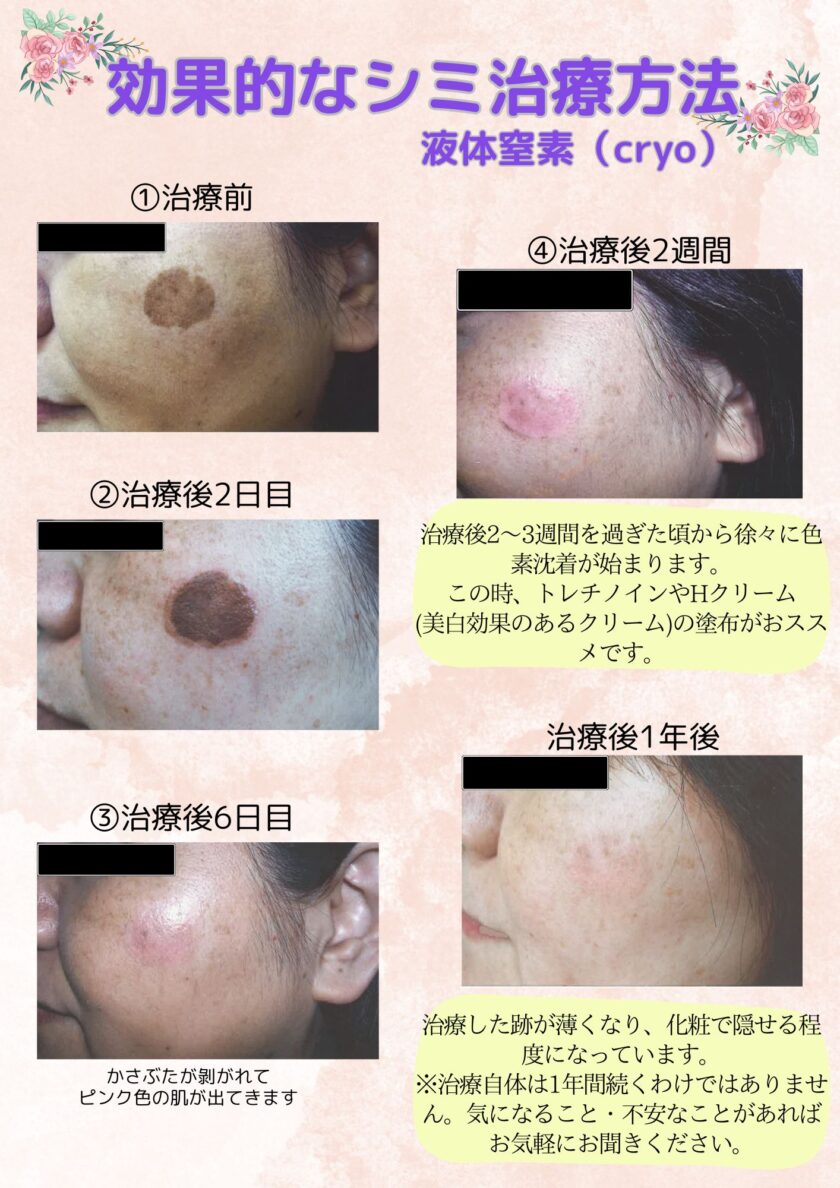 シミ治療 | 北部皮フ科クリニック