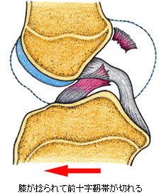 整形外科・スポーツ診療科｜膝前十字靭帯損傷｜順天堂大学医学部附属