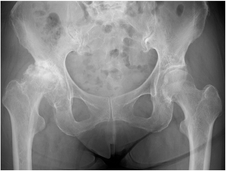 人工股関節について - 人工股関節置換術 | 千葉市立青葉病院