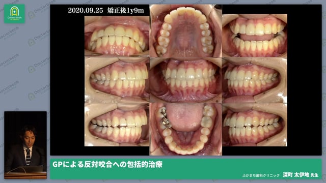GPによる反対咬合への包括的治療 深町 太伊地先生 | Doctorbook