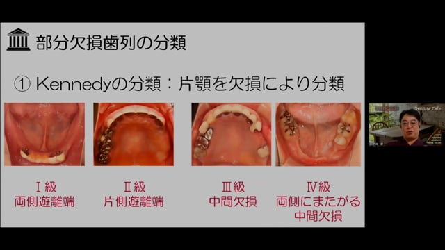 部分床義歯治療で役立つ欠損歯列の分類～活用法と注意点～│Denture