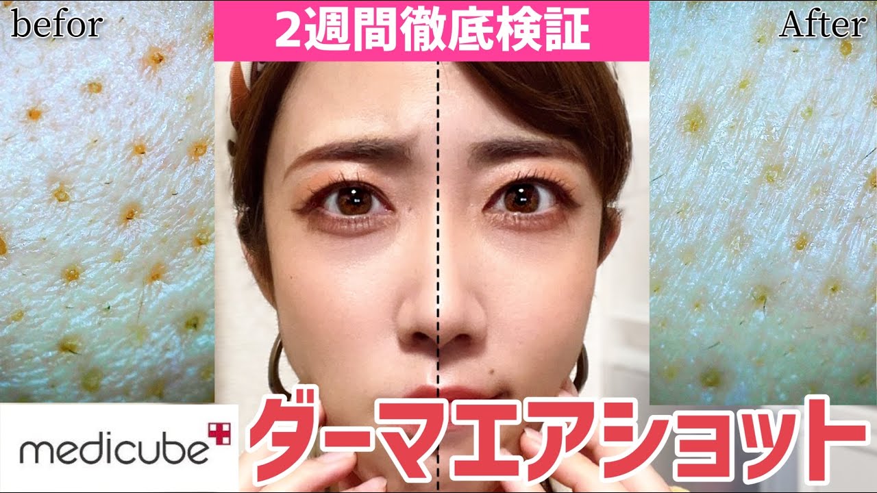 ダーメペン】毛穴縮小⁉激バズりメディキューブのホーム美顔器！【韓国