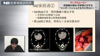 低侵襲の境地 肝疾患に対する “インターベンショナルラジオロジー