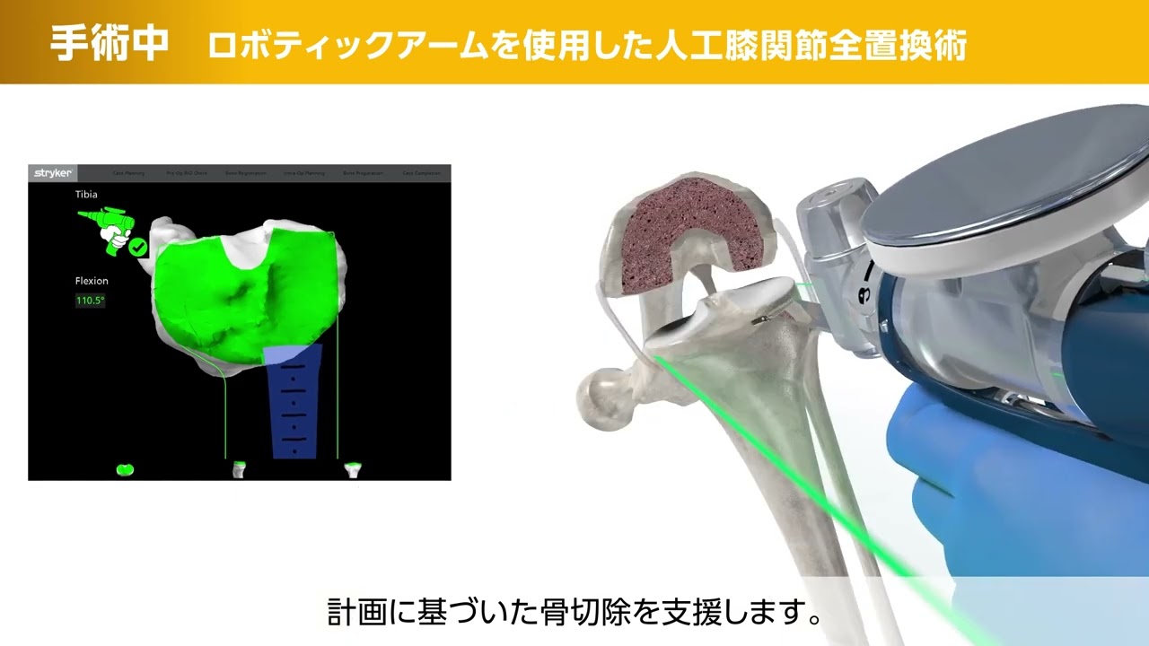 人工膝関節全置換術 - 一般財団法人脳神経疾患研究所 附属 南東北福島病院