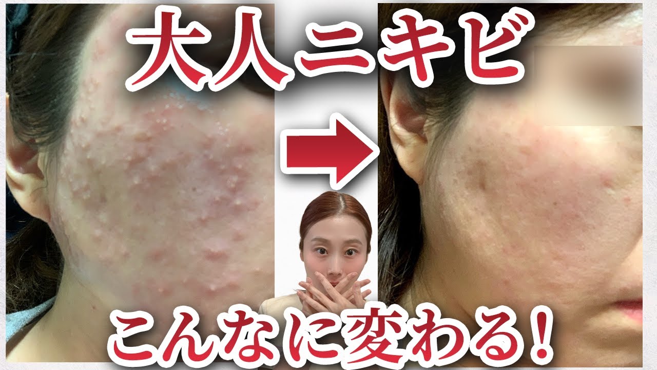 ニキビ肌必見！】ニキビ・黒ずみを集中ケア！ LHALA SHOT Q -ララ