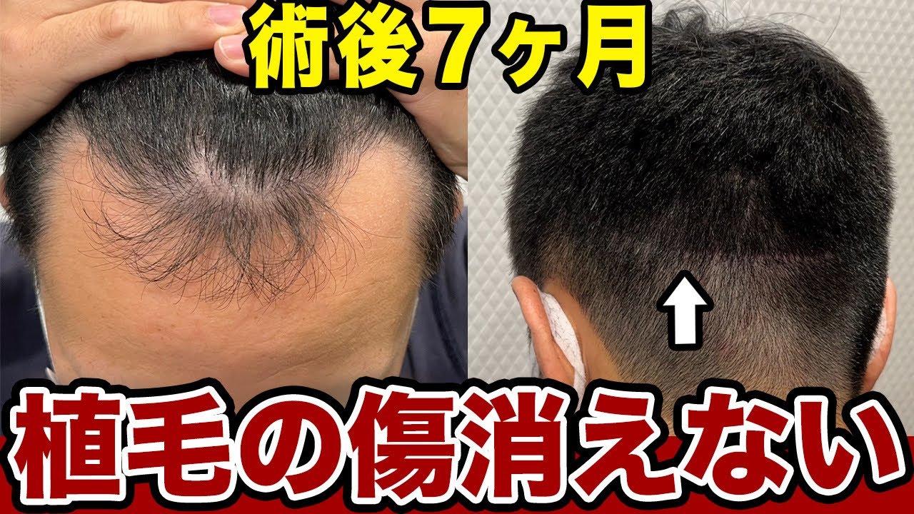 FUT手術の注意点】植毛をして7ヶ月経過した傷跡の状態！ - YouTube