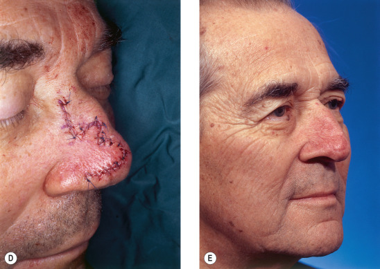 Local flaps for facial coverage | Plastic Surgery Key