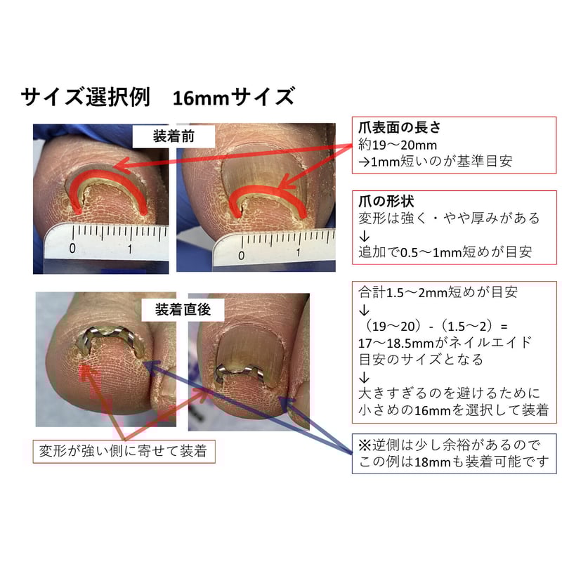 ネイル・エイド 16mm 】 巻き爪矯正・巻き爪治療・ブロック・ロボ