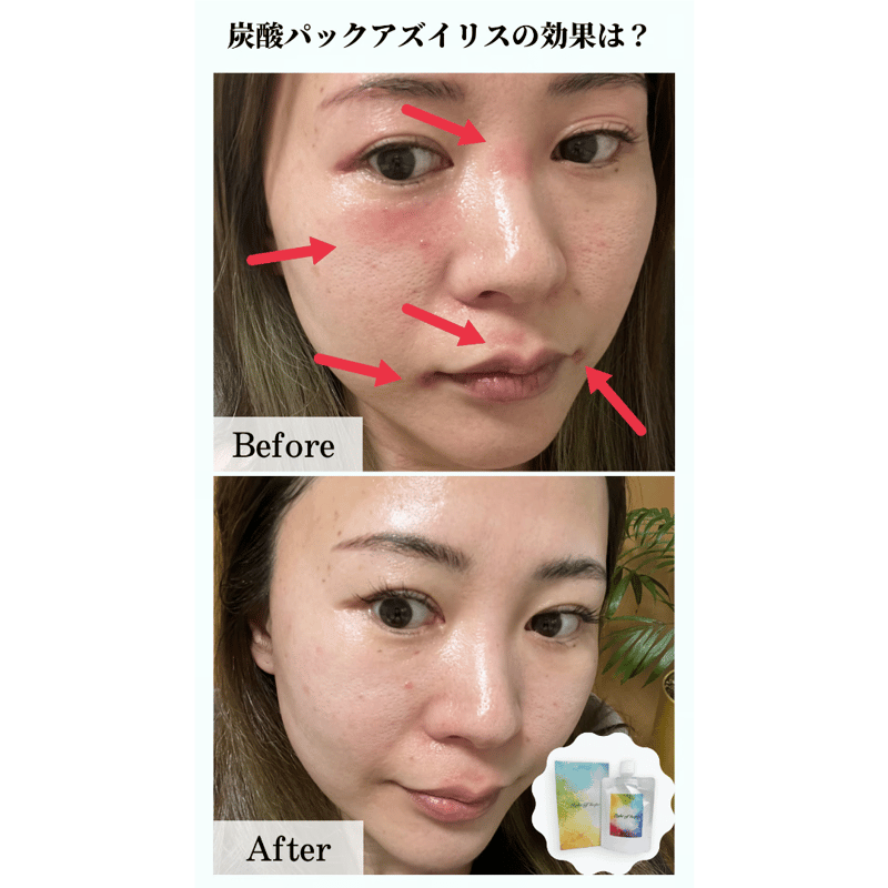 アズイリスミニ】(As_iris)炭酸ガスペーストパック | 【アズイリス正規