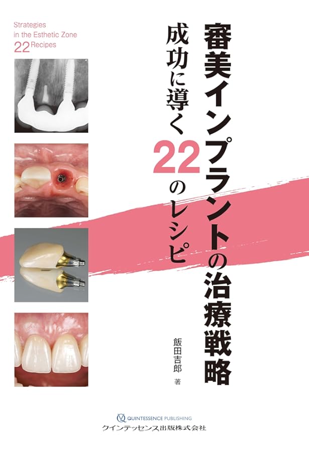 即時治療の真髄: 補綴的要件を達成するための即時埋入と即時負荷