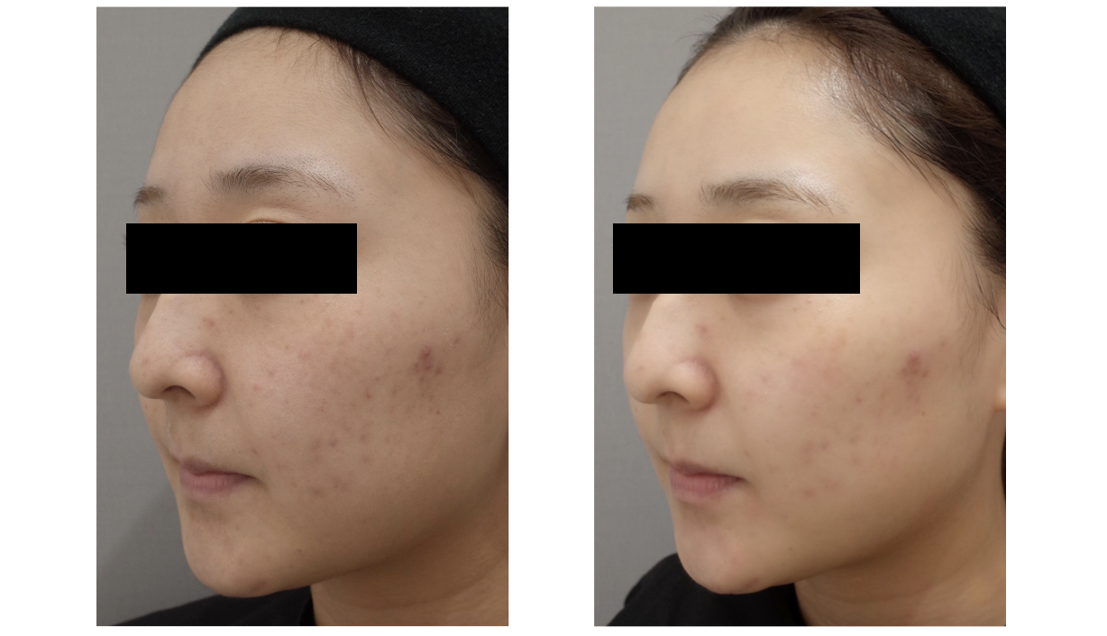 プラズマシャワー - 東京・六本木の美容皮膚科なら今泉スキンクリニック