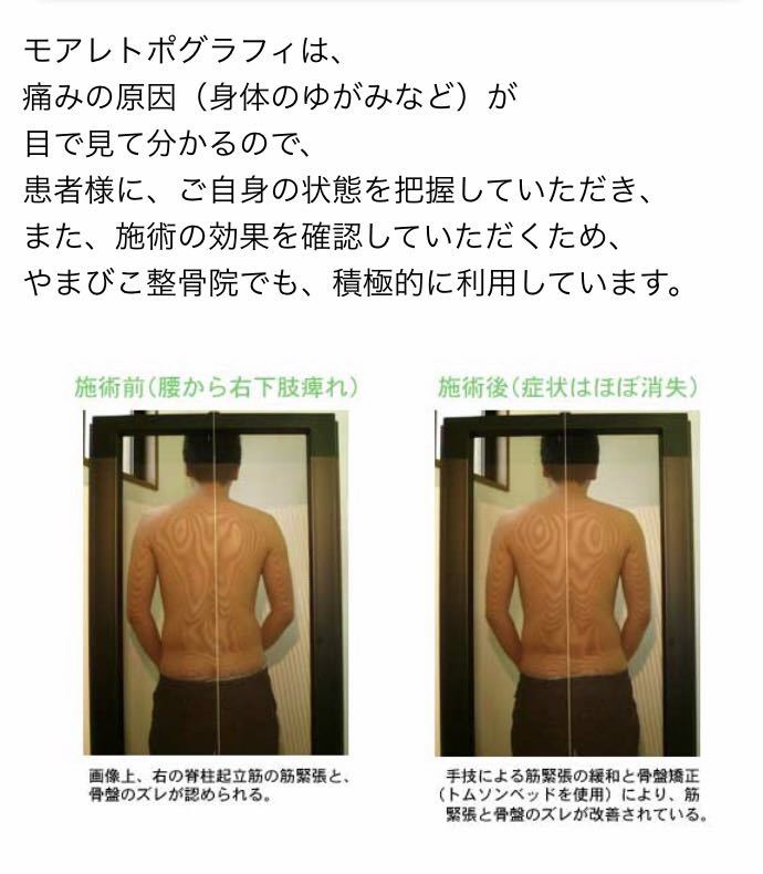 激安！モアレトポグラフィー モアレ 姿勢 分析 等高線 整体 歪みチェック