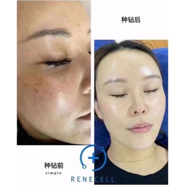 ルネセルReneCell ダイヤモンドピール セット水光肌 整形3種セット